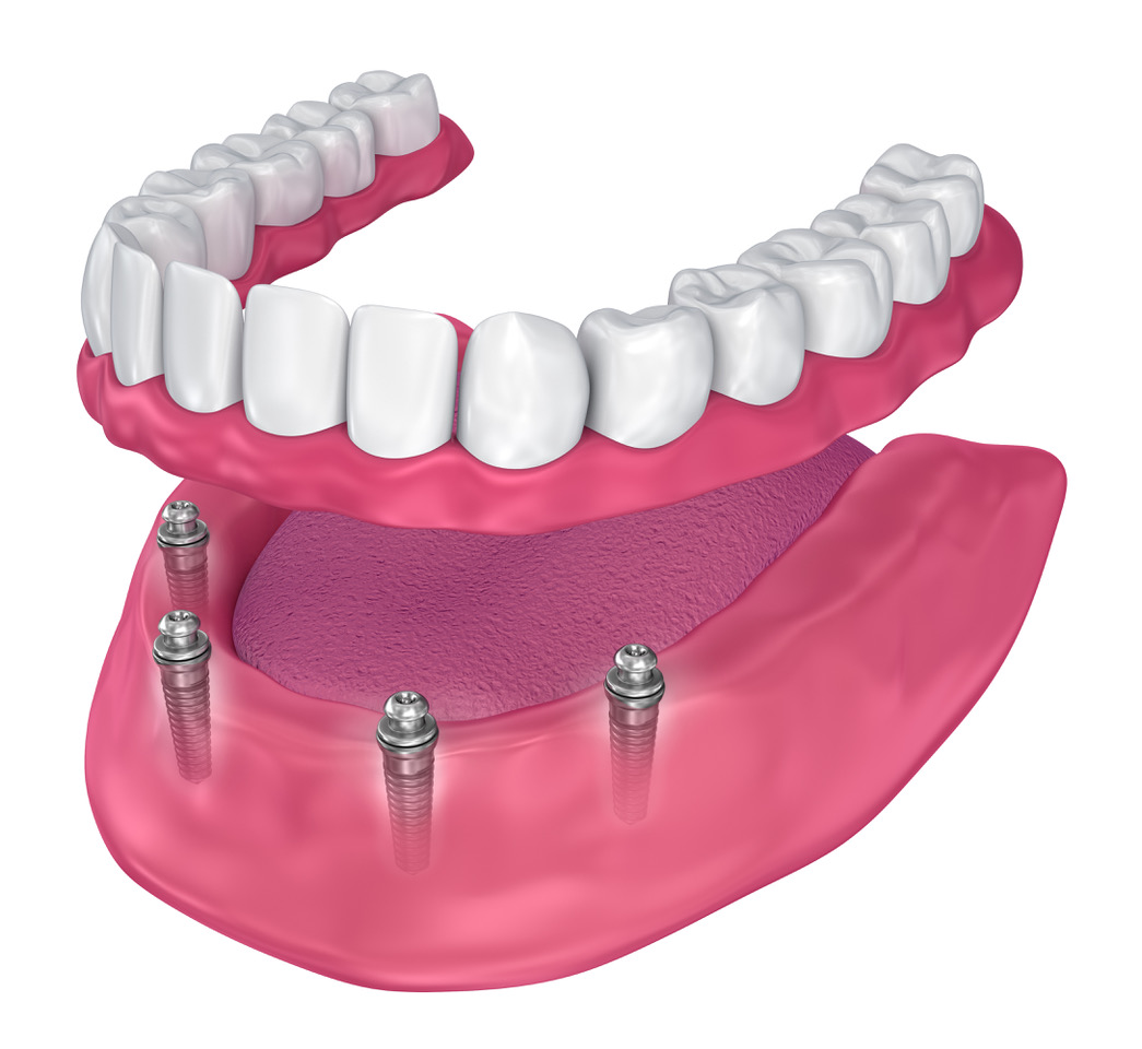 Dental Treatments in Mission Viejo